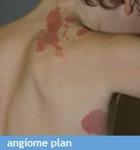 angiome plan
