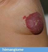 hemangiome