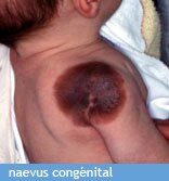 naevus