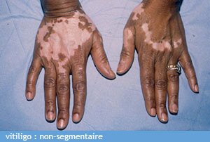 vitiligo non segmentaire