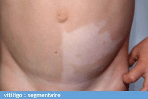 vitiligo segmentaire